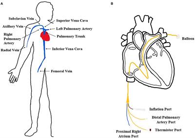 An Inexpensive Cardiovascular Flow Simulator for Cardiac Catheterization Procedure Using a Pulmonary Artery Catheter